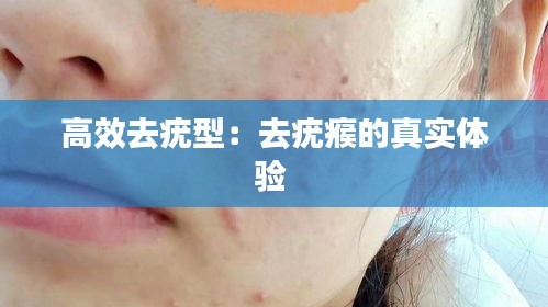 高效去疣型：去疣瘊的真实体验 