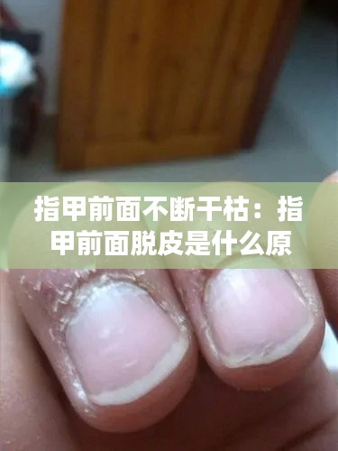 指甲前面不断干枯：指甲前面脱皮是什么原因 