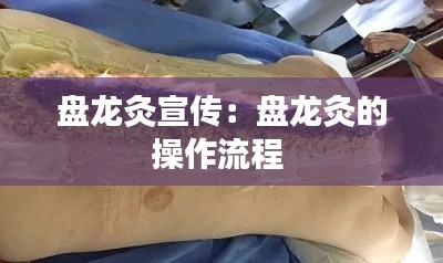 盘龙灸宣传：盘龙灸的操作流程 